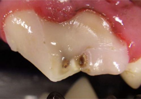 periodontal fistula